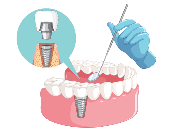 https://dramuljain.com/wp-content/uploads/2023/01/Dental-Implant-1.png